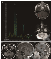 MGluR1 Encephalitis